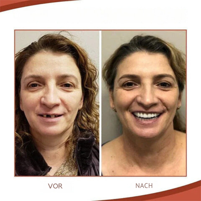 Silicone Dental Prosthetics for Comfortable Fit – Daily Use, Natural Look
